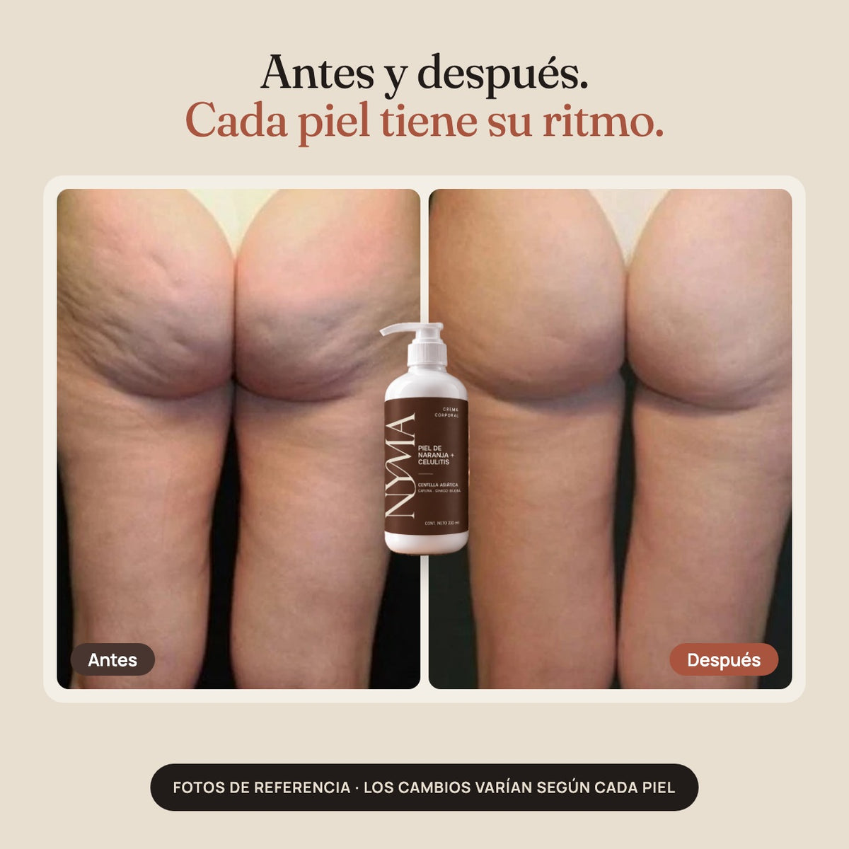 Piel de naranja + celulitis