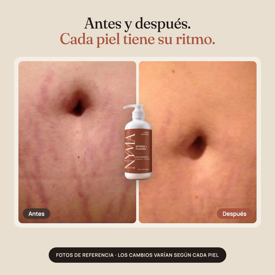 Estrías + flacidez